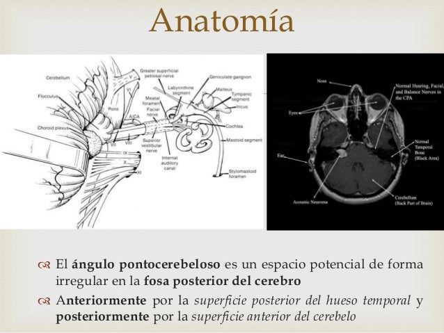 angulo pontocerebeloso